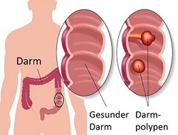 Anatomische Darstellung eines gesundes Darmabschnittes und eines mit Darmpolypen 
