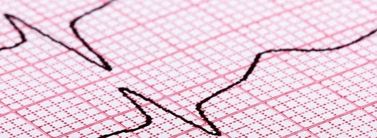 Herzrhythmusstörungen dargestellt auf einem EKG-Diagramm Ausdruck